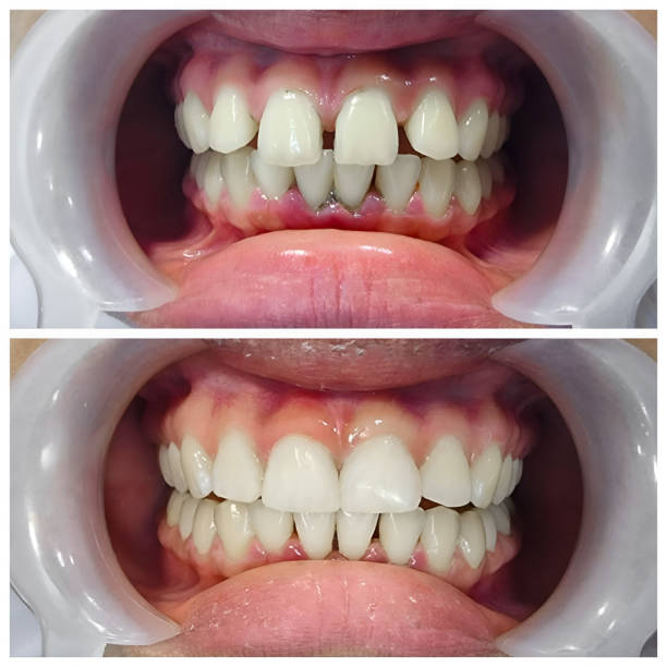 Best Full Mouth Reconstruction  in Duluth, GA